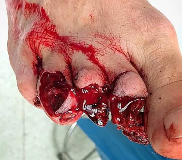 Lawn mower accident cut toes